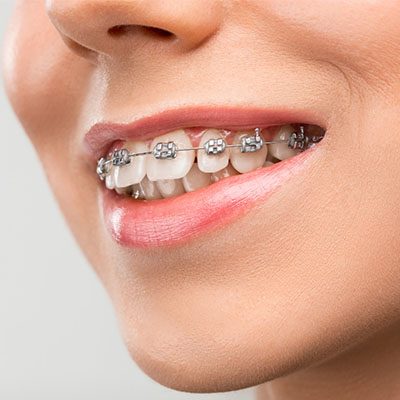 orthodontics thornton maitland nsw