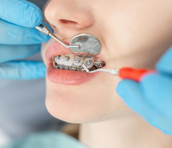 types of orthodontic treatments